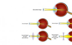 altersweitsichtigkeit-ursachen