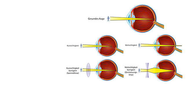 Altersweitsichtigkeit: Ursachen